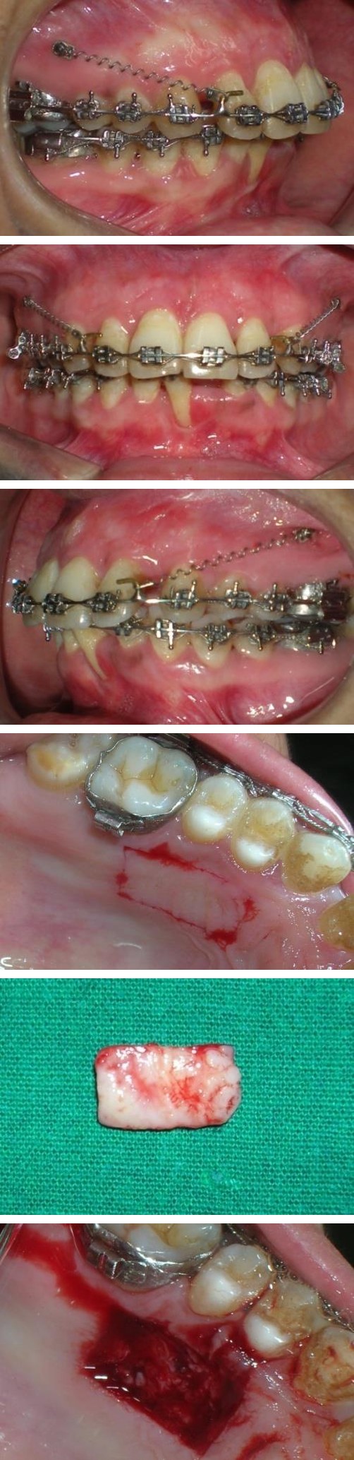 Figure 3: Intrusion-retraction of upper anteriors with TADs.