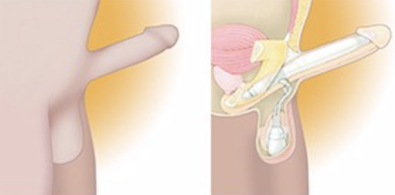 Figure 2: Two-component inflatable PP. Adapted from bostonscientific.com.