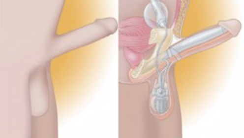 Figure 3: Three-component inflatable PP. Adapted from bostonscientific.com **Semi-rigid PP:** Semi-rigid PPs consist of two cylinders placed in the corpora cavernosa. These devices have a central core that allows the penis to be curved downwards for concealment and upwards for sexual activity. They are a more economical option, have a high mechanical reliability and are more simple to use and to surgically implant, but they present a greater risk of erosion, don’t allow expansion of circumference and length and the rigidity is constant, which makes it difficult to hide the device, since the penis maintains the same volumetry (Figure 4) [2,13].
