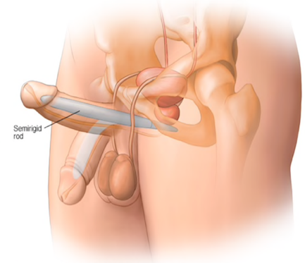 Figure 4: Semi-rigid PP. Adapted from Mayo Foundation for Medical Education and Research