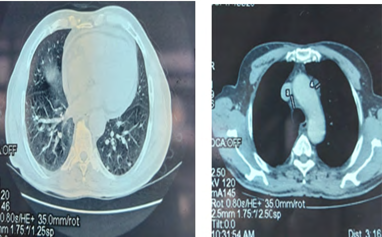 Figure 1: Bilateral pulmonary nodules.