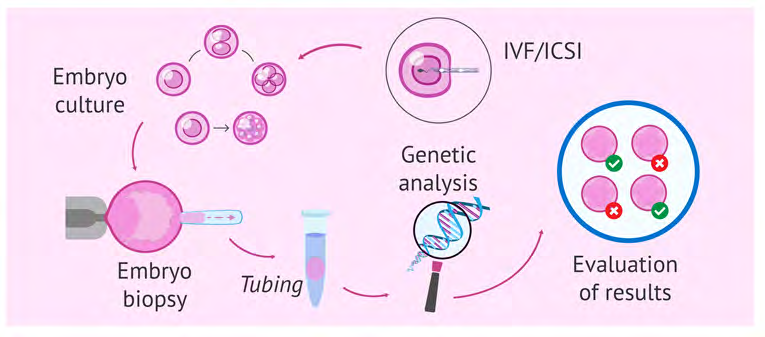 Figure 1: Process of PGD (Preimplantational Genetic Diagnosis).