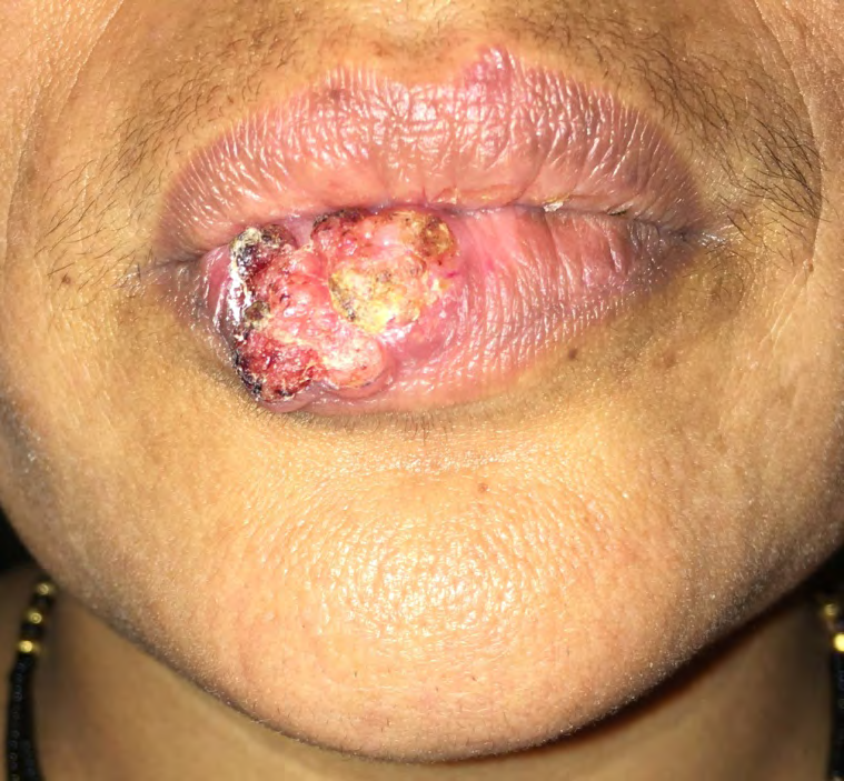 Figure 1: A 46-year-old woman presented with a 2 x 3 cm vegetative mass over the lower lip. (a) Frontal view. (b) Oblique view.