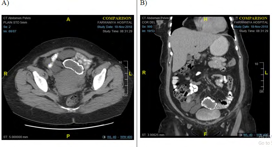Figure 1: CT abdomen and pelvis showing suprapubic and right iliac fossa cysts.
