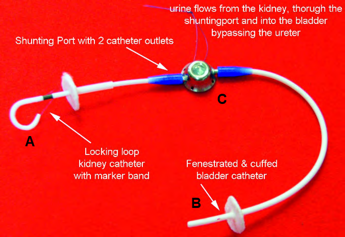 Figure 1: Subcutaneous ureteral bypass system. The system comprising a pigtail catheter with a polyurethane locking loop that is placed in the renal pelvis (A), a radiopaque silicone fenestrated bladder catheter with a polyurethane cuff (B), and a titanium bypass port that is positioned subcutaneously (C). Font: https://veterinary-instrumentation.co.uk/catalog/product/view/id/6787/s/the-sub-a-subcutaneous-ureteral- bypass-system/category/1960/