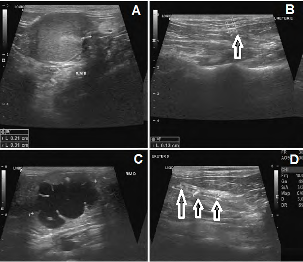 Figure 2: Abdominal ultrasonography of kidneys and ureters. A. Left kidney with irregular margins, high echogenicity and loss of corticomedullary architecture and definition. Mineralization points in pelvic recess. B. Presence of intraluminal microlithiasis (0.13-0.21 cm of diameter) in the final third of the left ureter (arrow). C. Right kidney with irregular margins, high echogenicity and loss of corticomedullary architecture and definition with significant dilation of renal pelvis (hydronephrosis). D. Right ureter with presence of microlithiasis since cranial third to caudal third, measuring between 0.11 to 0.49 cm, causing obstructive process. Font: Errante, 2022.