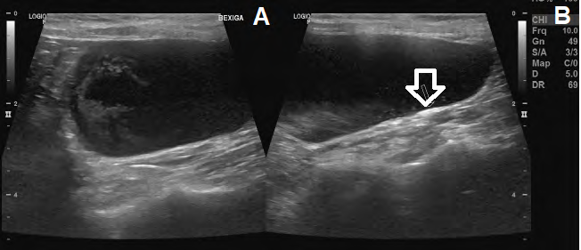 Figure 3: Abdominal ultrasonography of bladder. A. Distended bladder with anechogenic content and sediment in suspension. B. Bladder presenting slim and regular wall (0.09 cm) (arrow). Font: Errante, 2022.