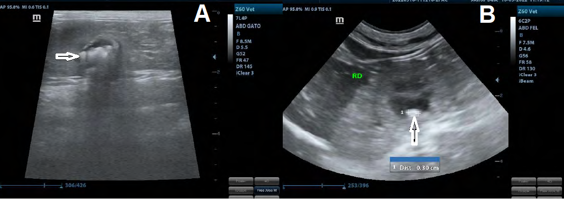 Figure 5: Abdominal ultrasonography after implantation of the subcutaneous ureteral bypass system in right kidney. A. Dilation of the renal pelvis, with anechoic content and oval hyperechoic structures (microlithiasis) (arrow). B. Visualization of tubular structure in kidney pelvis (bypass) (arrow). Font: Errante, 2022.
