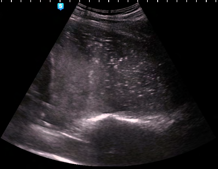 Figure 3: Left sided pleural effusion with hyperechoic dots – hematothorax.