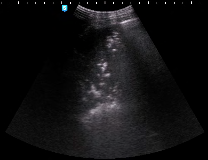 Figure 4: Hipoechoic area in right lower lobe lung with “air” bronhogram representing pneumonia.