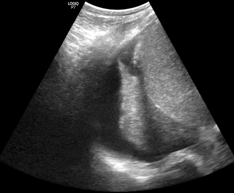 Figure 5: Hiperechoic area of atelectasis without dynamic “air” bronchogram sign surrounded by pleural effusion.
