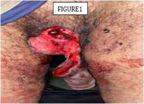 Figure 1: Pre-operative image of an almost complete section of the penis.
