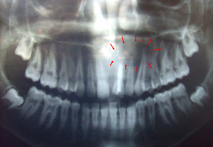 Figure 2: Orthopantomogram showed the defined borders of the periapical lesion, and Calcium Hydroxide intracanal dressing for the tooth 21 after one week of treatment.