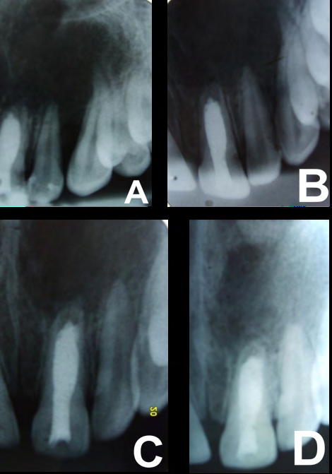Figure 3: Periapical radiographs revealed the apexification and healing process. (A) After one month (B) After four months (C) After six months (D) The case after eight months.
