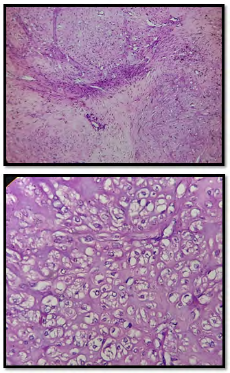 Figure 3: Microscopic appearance of fibroid (with smooth muscle fibers in criss- cross pattern with changes of hyalinization and cartilaginous metaplasia).