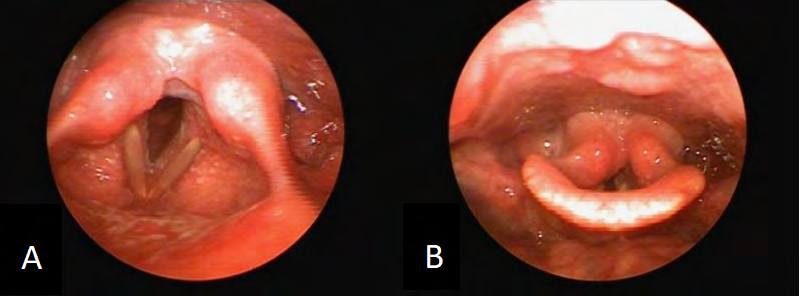 Figure 1: In Figure A, granular and patchy herpetic lesions of the laryngeal cavity mucosa are seen, with no damage to bilateral vocal cords, and in Figure B, no abnormality is found in the external laryngeal cavity mucosa.
