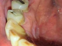 Figure 1: Squamous cell carcinoma in the anterior and lateral floor of the oral cavity: ulcer adjacent to mandible (arrows).