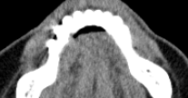 Figure 3: Supraomohyoid neck dissection with preservation of the facial vein and artery.