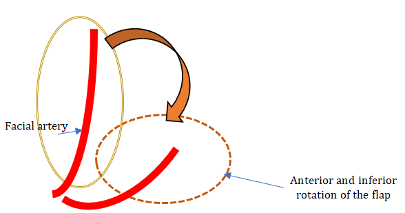 Figure 4: Myomucosal buccinator flap with antero-inferior pedicle (facial artery) Anterior and inferior rotation of the flap to reconstruct the floor of the mouth.