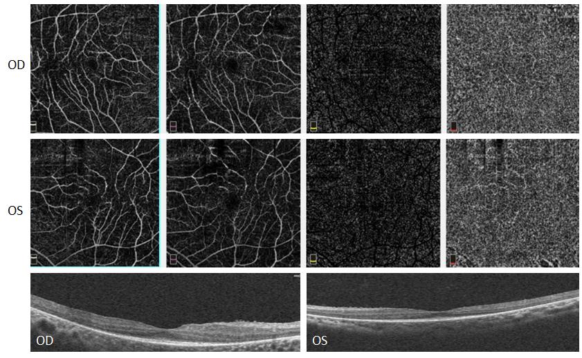 Figure 2: OCT Angiography and SD-OCT of the right and left eye of a patient with moderate retinitis pigmentosa.