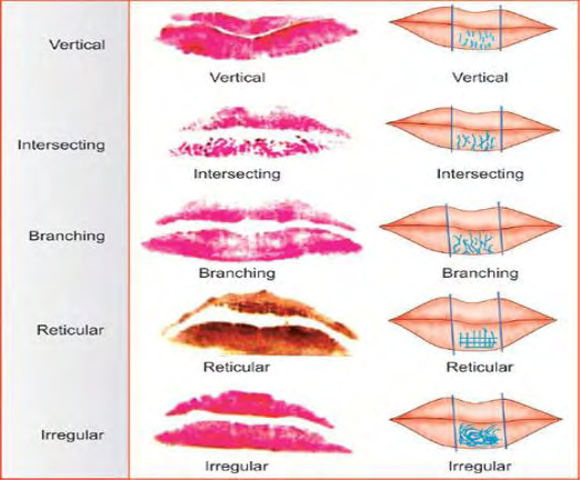 Figure 4: Yasuo Tsuchihashi and Kazuo Suzuki classification Renaud’s classification is yet another classification which was concluded by the scientist after studying more than 4000 lip print samples. According to this classification the lip prints are grouped into 10 different categories from type ‘a’ to type ‘j’. The different categories are mentioned in the Figures 5 and 6.