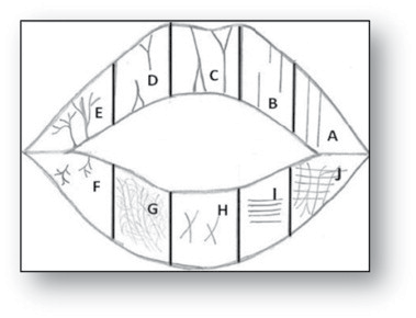 Figure 6: Diagrammatic representation Renaud’s classification The Kasprzak JC [8] classification was given for the individual lip prints. The classification was based on all the individual characteristics found on the lip prints. The characteristics are given in the Figure 6.