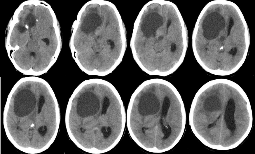 Figure 1: Non contrast CT shows homogenous upper-sell and right frontal lesion with peripheral. The mass is compressing over the lateral ventricle.