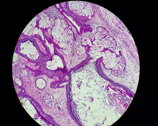 Figure 2: Benign squamous epithelium and keratinization and lamellar keratin of epidermoid cyst tumor (H&E, 100×).