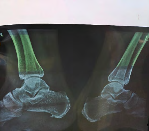 Figure 1: Calcaneous spur of posterior aspect of bilateral heels.