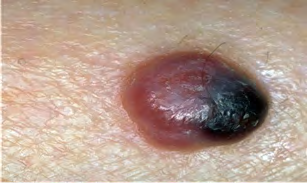 Figure 2: Nodular melanoma malignum (Source [5]).