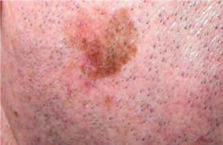 Figure 4: Lentigo melanoma malignum (Source:[5]).