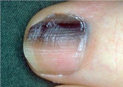 Figure 5: Acrolentiginous melanoma (Source [5]).