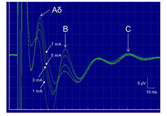 Figure 3: Typical multiple peaks in the recorded action potentials of the Aδ, B, and C fibers. Electrical stimulation was applied with intensities ranging from 1, 3, 5 and 7 mA, with a pulse width of 0.1 ms and a pulse repetition rate of 3 Hz.