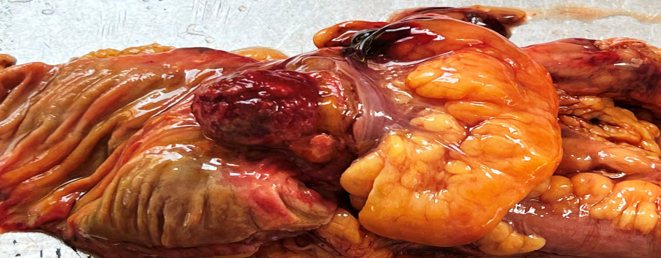 Figure 1: Cecum cut open showing a single circumscribed, polypoidal nodular mass measuring 3 cm with surface ulceration.