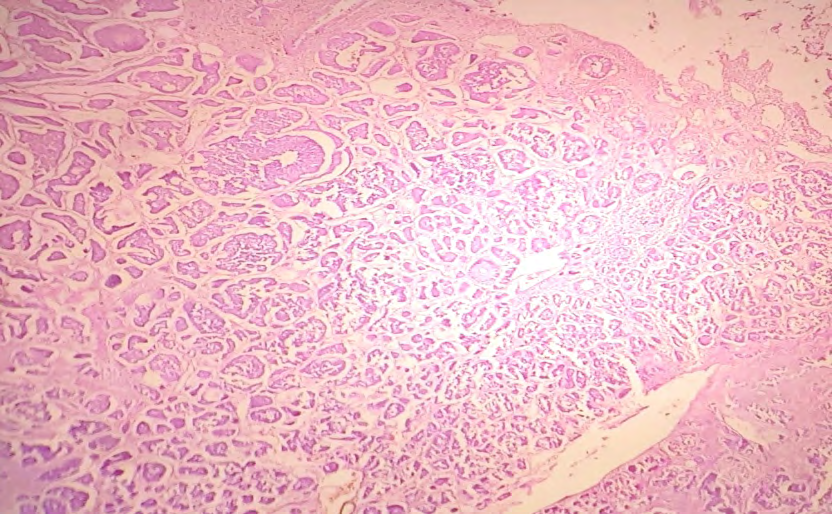 Figure 3: Photomicrograph showing the tumor proliferates in an insular, solid to cribriform growth pattern (H and E stain, 40x).