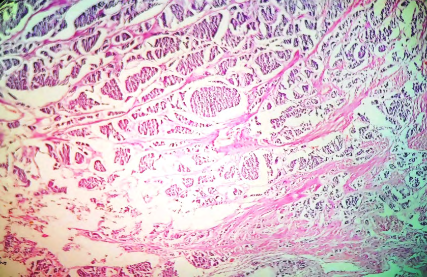 Figure 4: Neuroendocrine tumor invading muscularis propria of caecum. (H and E stain, 40x).