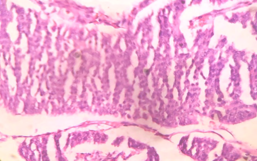 Figure 5: Neuroendocrine tumor, neoplastic cells are small, monotonous having round nuclei ,with salt-and-pepper chromatin and eosinophilic cytoplasm(H and E stain, 100x).
