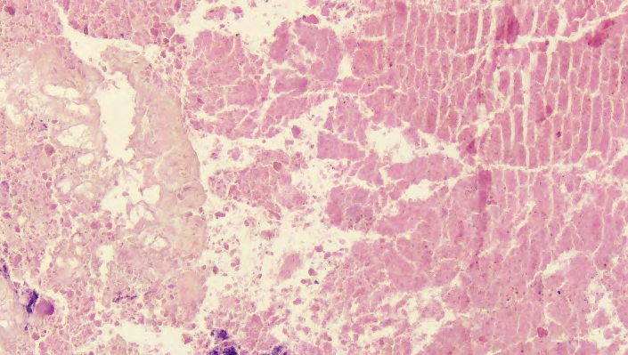 Figure 4: HSAT wrapped in the greater omentum of the spleen in the subcutaneous tissue.