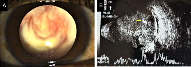 Figure 1: (A) Slit lamp bio microscopy revealed neovascularization of the iris and a greyish-white vascularized intraocular mass filling the vitreous cavity, reaching just behind the posterior capsule of the clear crystalline lens in the right eye. (B) B-scan ultrasonography of the right eye showed a mass arising from the retina with variable internal reflectivity and foci of very high amplitude spikes suggestive of intralesional calcification (marked by arrow).