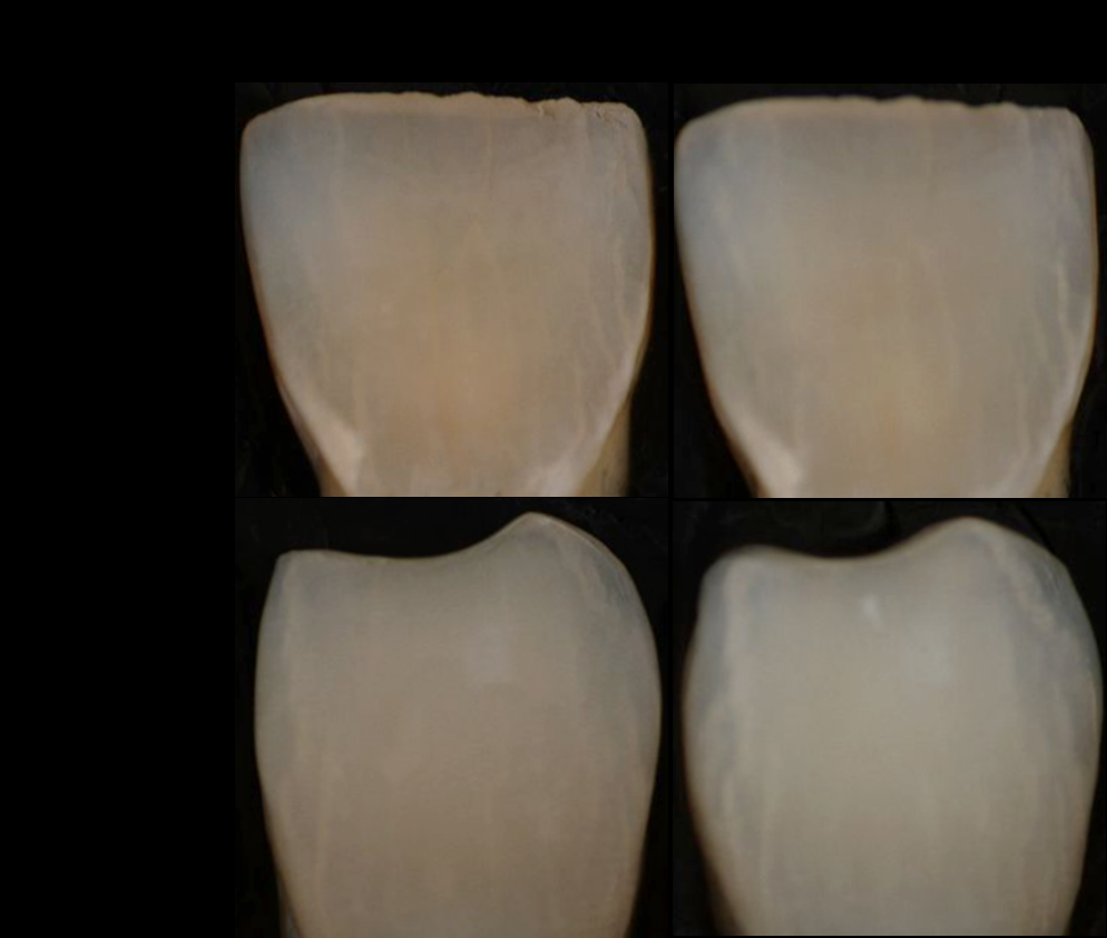 Figure 1: A total of 30 human incisors in sound condition and with no signs of fluorosis or caries were obtained, cleaned, disinfected and transported in 0.1% thymol to prevent microbial growth before use (Therametric Technologies, Inc., Nobelsville, IN). These teeth were selected from a batch to ensure that all had a starting classical Vita Shadeguide (Vita, Zahnfabrik, Germany) value of 8 or higher on a scale of 1-16. The roots were removed by a diamond saw (Isomet, Buehler, Lake Bluff, IL) and the samples were mounted in Durabase hard chairside reline (Reliance Dental Mfg, Alsip, IL) with the labial surface up (and all other surfaces covered). The samples were then cleaned gently with a standard rotary polisher and pumice paste. To prepare for microhardness measurements, a ~3 mm diameter area toward the bottom of the enamel surface was formed by serially polishing up to a 1 µm diamond grit finish (Forcipol 1V with Forcimet, Metkon Instruments, Inc., Bursa, Turkey).