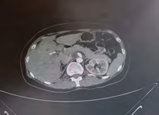 Figure 2: Figure G-I show a stricture in the common bile duct via MRCP.