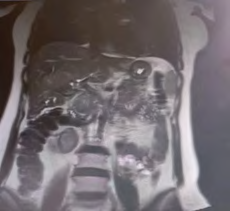 Figure 3: This is a cholangiogram, revealing a narrowing in the common bile duct