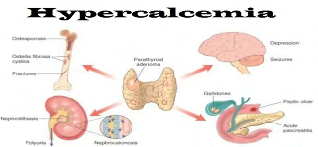 Figure 2: Hypercalcemia-Causes, Signs, Symptoms, Workup, Treatment [Source-3].