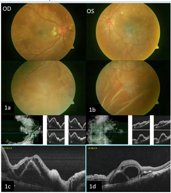 Figure 1: Fundus photos of both eyes show subretinal exudative fluid and retinal folds and cotton wool spots, supported by OCT imaging.