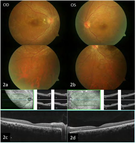 Figure 2: Fundus examination post treatment showing resolution of sub retinal fluid and cotton wool spots and hemorrhages, supported OCT imaging.