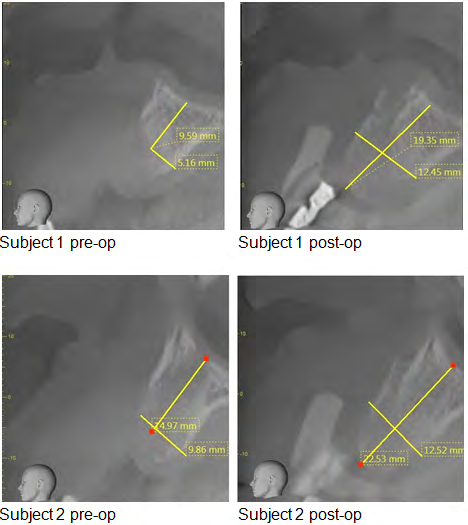 Figure 2: Cone-beam CT height and width measurements for subjects 1 and 2.