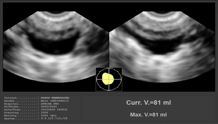 Figure 1: Screen appearance of ultrasonographic PVR measurement. The target should be in the middle of the yellow area to achieve a correct calculation. The ultrasonographic view shows the bladder filled with residual urine.