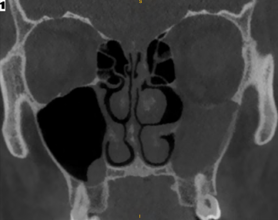 Figure 1: Coronal CT displaying left sided Silent Maxillary Sinus Syndrome with uncinate process atelectasis and orbital floor depression.