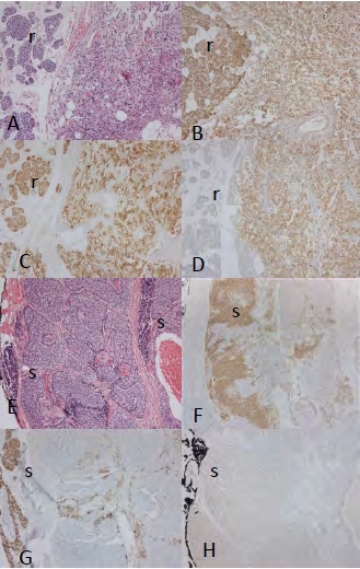 Figure 2: Parathyroid Adenoma and Atypical Adenoma.