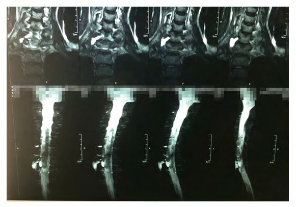 Figure 2: Magnetic resonance image with myelography effect. Presence of pseudomeningoceles in roots C8 and D1, signs of radicular avulsion.